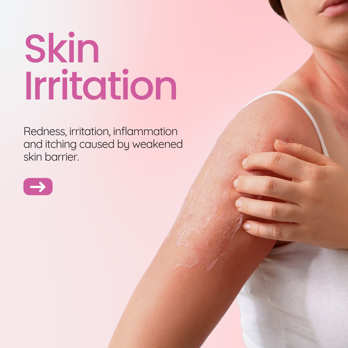 Skin Irritation